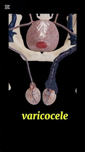 Varicocele#andrology#1millionviews#3danimation#viralvideo