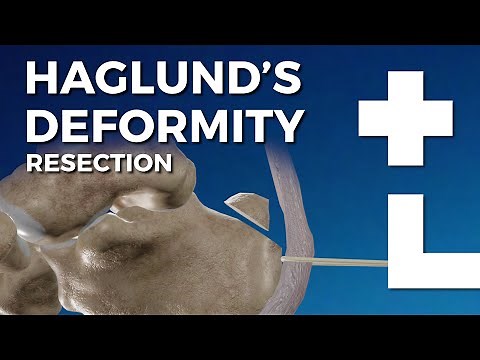 Haglund's deformity resection - Dworska hospital®