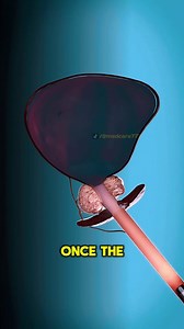 7.1K views · 94 reactions | Enlarged Prostate Treatment How TURP Is Done (3D Animation) #prostat #men #stitch #hear #3danimation | Surgery Page | Facebook