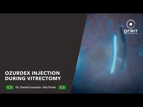 Ozurdex Injection during Vitrectomy