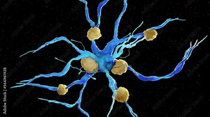 3D rendered medical animation of a nerve cell affected by amyloidosis