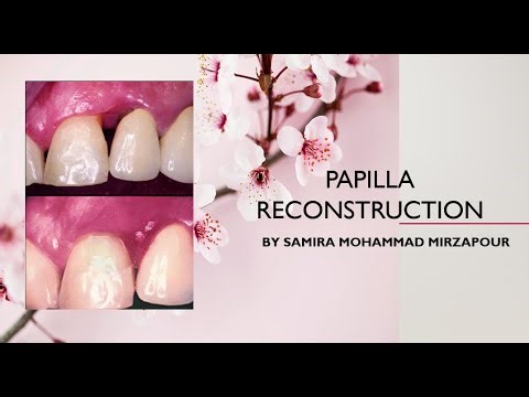 Papilla Reconstruction part 1 of 5; Intro