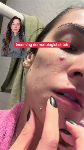 Safe Pimple Popping Tips from a Dermatologist