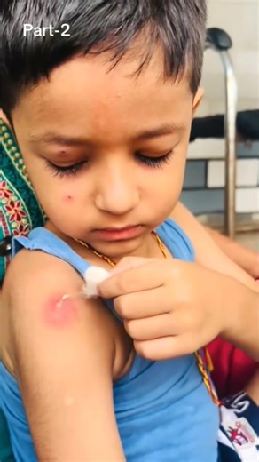 Says Yes Before Open Watching. | Pimple Popping