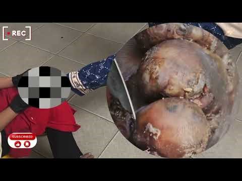 🔍 Unseen Jigger Cavities – Hardened Dry Skin Lifted Off Fully! #DO323