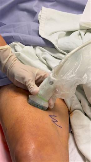 Naveed Tahir, MD on Instagram: "Individualized ultrasound guided adductor canal nerve block training #yourbestanesthesia #anesthesia #anesthesiology #anaesthesia #anaesthesiology #anesthesiologist #anaesthetist #anaesthesiologist #anesthesiaresidency #anesthesiaresident #crna #nurseanesthetist #nurseanesthesia #srna #caa #regionalanaesthesia #nerveblock #nerveblocks #nerveblockinjection #ultrasoundguided #ultrasoundguidedinjection"