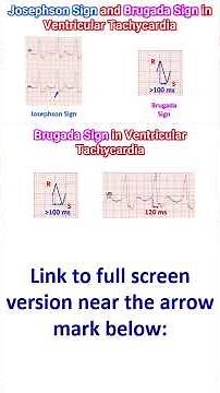 Josephson Sign and Brugada Sign in Ventricular Tachycardia