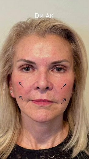 Deep Plane Face Lift Neck Lift Brow Lift In Turkey