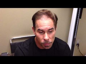 Jose's Review: 2 Weeks After a Bosley Hair Transplant