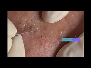 Most satisfying acne treatment,blackheads popping on nose,video face skin care with relaxing music E