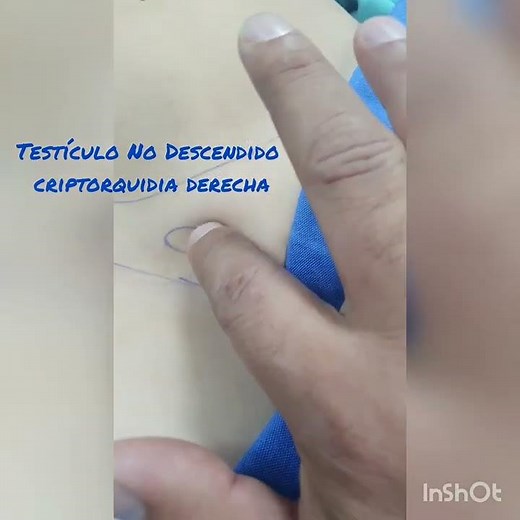 Testículo No descendido, criptorquídia derecha