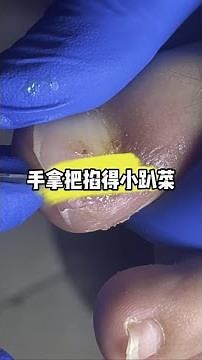 Nail fold inflammation and ingrown nail removal process