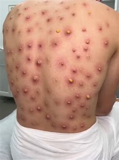 Effective Body Acne Treatment for Clear Skin