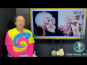 Cone beam CT scan showing elongated styloids, misalignments, and more. Hauser Neck Center