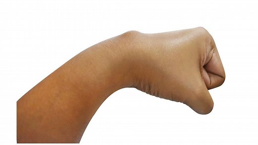 Kyste synovial : symptômes, causes et traitement