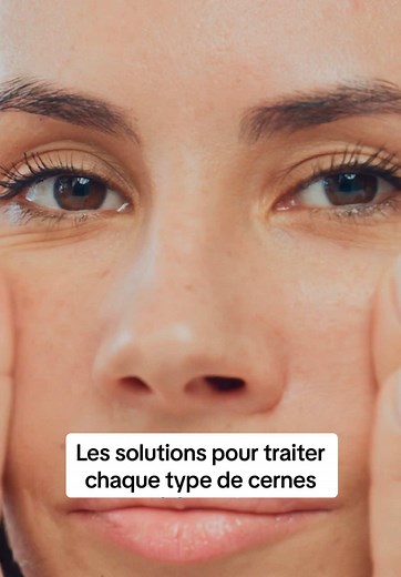 Solutions pour traiter les cernes : Guide complet