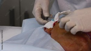 Thread lifting for a male patient is an innovative method of correcting face lifting with special ultra-thin and durable threads with multidirectional notches.