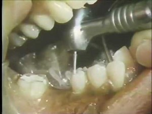 Clinical Procedures in Bridge Construction