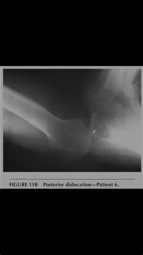 normal shoulder in axillary view and ant/posterior glenohumeral dislocation #radiology