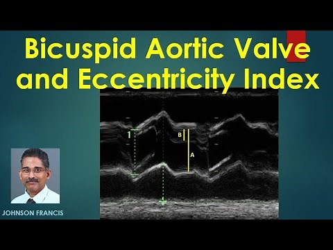 Bicuspid Aortic Valve and Eccentricity Index