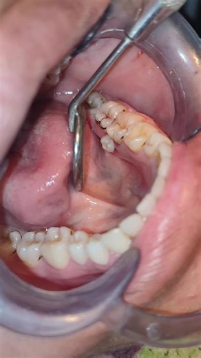 Expert Tooth Extraction Methods by Dentists