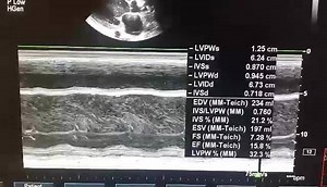 62 reactions · 28 shares | Case 43: Significant Spontaneous Echo Contrast In Left Ventricle ( DCM/Severe LV Dysfunction / LVEF : 15% in M- Mode / LVEF : 10% In Simpson's Method. Echo Report Dilated Cardiomyopathy Global Hypokinesia of LV, Severe LV Dysfunction, Dilated LA & LV, Severe Spontaneous Echo Contrast in LV, Mild MR, Minimal PE / EF : 15% in M-Mode/ EF 10% In Simpson's Method. | Interesting cases in Echocardiography | Facebook