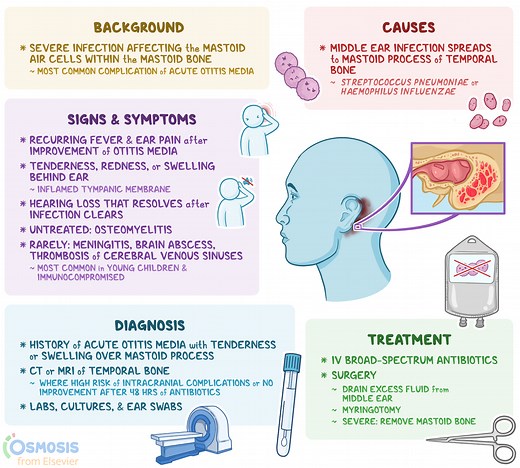 Mastoiditis: What Is It, Causes, Signs and Symptoms, and More | Osmosis