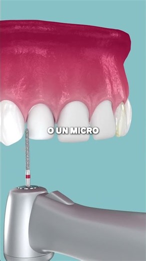 Dental Aesthetics and Veneers: Discover the Truth About Tooth Preparation and Care. 💡