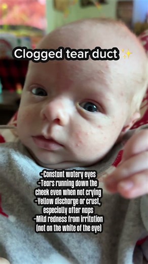 Info about clogged tear ducts! #newborn #parentingtips