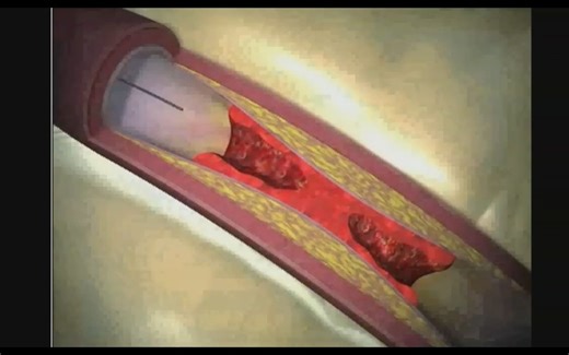 科普-下肢深静脉血栓的形成与治疗