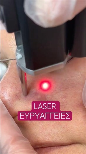 Laser για Ευρυαγγείες στη Μύτη #spiderveintreatment