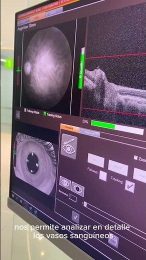 OCT Optovue Solix. Novovisión.