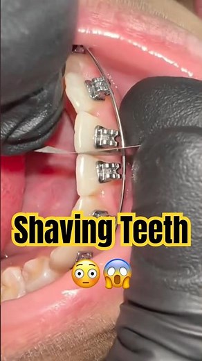 Shaving teeth for braces?! ⚙️😬 #braces #orthodontist #dental