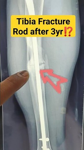 3️⃣ years after tibia fracture🔥| 3 yrs. follow up |#tibia #tibiafracture #fracturerecovery #fracture