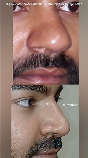 Deviated Septum Big Bulbous Nose Tip Rhinoplasty, India, Delhi