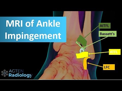 MRI of Anterolateral Ankle Impingement