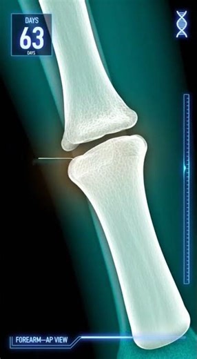 Fracture Bone Healing In X-ray || The Road To Recovery