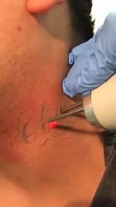 126K views · 557 reactions | Share this with someone that you know that is being held down by a tattoo of the past...@cleancanvaslaser #cleancanvaslaser #lasertattooremoval | Clean Canvas Laser Tattoo Removal | Facebook
