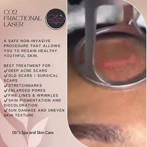 117 reactions · 29 shares | CO2 FRACTIONAL LASER is a safe...