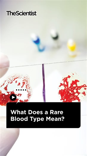 3.2K views · 20 reactions | Matching donor blood to a recipient is a standard part of medical practice. But what happens when there is no matching blood? In these cases of rare blood groups, an individual may find themselves on their own for a transfusion. Find out what happens next in this video! | The Scientist | Facebook