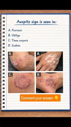 Dermatology MCQ | Auspitz Sign#AuspitzSign #DermatologyMCQ #MedicalEducation
