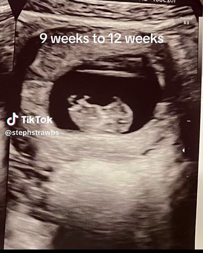 So crazy how fast they grow. You can also see twin B’s leg in the 12 week picture, they stay directly on top of each other 💙💙 #twinboys #ultrasound #twinpregnancy #9weeks #12weeks