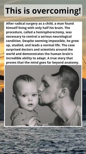 Man Thrives with Half a Brain! 🧠