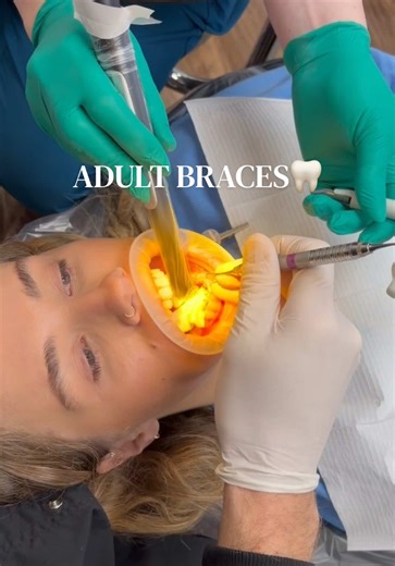 My dad with all the angles🦷👑 So excited to get rid of my snaggle tooth hahaha this was faster than any dental cleaning I’ve ever had😍 #dentist #braces #adultbraces #teeth #teethtok
