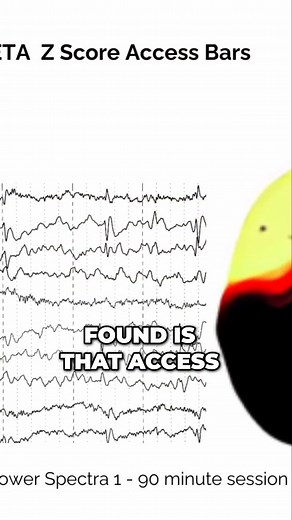 Discover how Access Bars can naturally transform your sleep.💤 Dr. Terrie Hope talks about how the Access Consciousness Bars can help you sleep better. She did a pilot study on the effects of the bars. 💆🏽‍♀️Treatment with Access Bars was associated with a significant decrease in the severity of symptoms of anxiety and depression and an increase in EEG coherence. These results suggest that Access Bars may be useful as a treatment for anxiety, depression, as well as with sleeping more soundly th