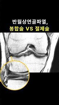 반월상연골 파열 봉합술과 절제술의 결과 차이