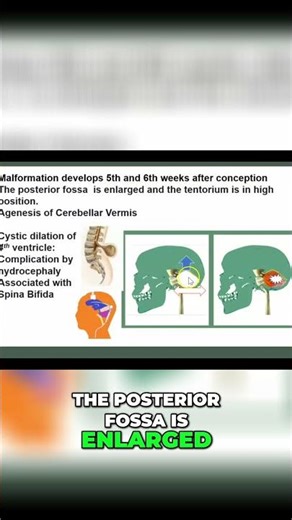 Dandy-Walker Syndrome: Causes: Cerebellar Vermis Agenesia #shorts