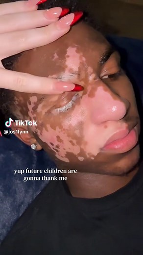 Vitiligo Couple & Future Kids | Relatable Trend
