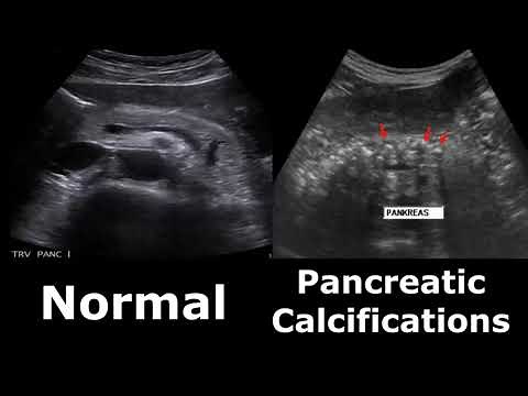 Pancreas Ultrasound Normal Vs Abnormal Appearances Comparison Pancreas Pathologies On Ultrasound