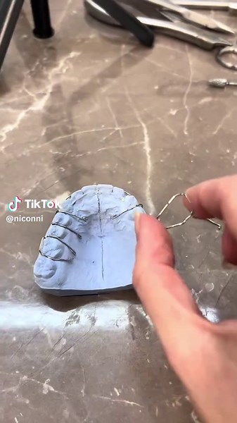 Transforming Smiles with Blue Dental Appliances